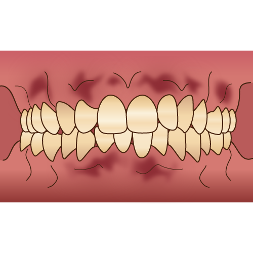 歯茎の黒ずみ（ガムピーリング）の画像