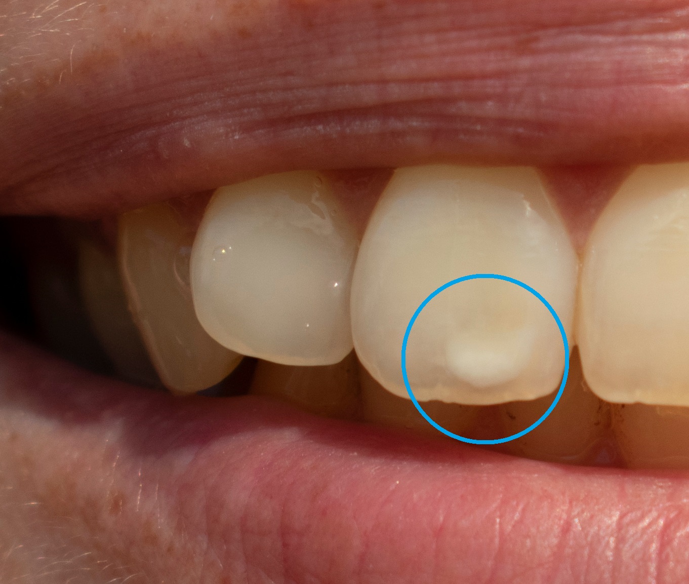 歯の白濁（ホワイトスポット）のイメージ画像