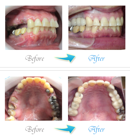 ザ・ホワイトデンタルクリニックのインプラント症例写真