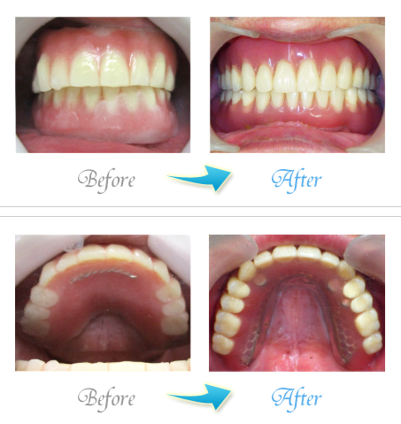 ザ・ホワイトデンタルクリニックのインプラント症例写真