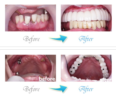 ザ・ホワイトデンタルクリニックのインプラント症例写真