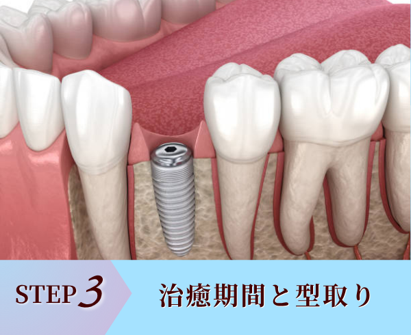 STEP3.治癒期間と型取り