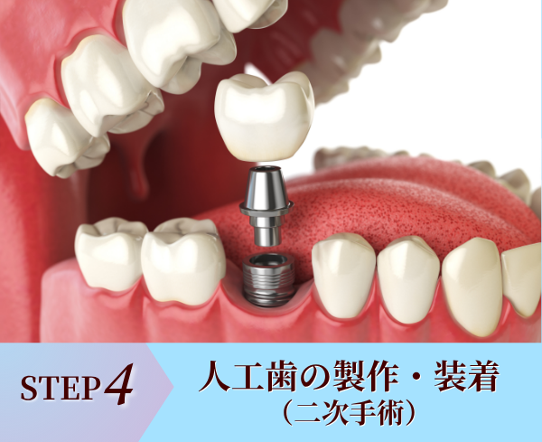 STEP4.人工歯(セラミッククラウン)の製作・装着