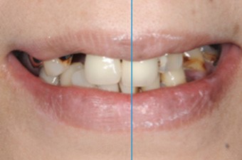 正中線と歯並びのバランスのイメージ画像