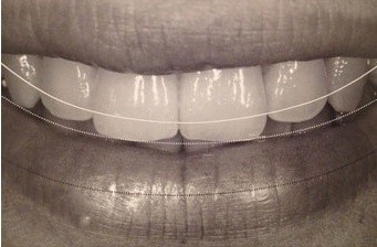 唇と歯の関係のイメージ画像