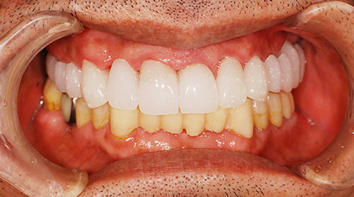 審美セラミック治療に使用する仮歯のイメージ画像