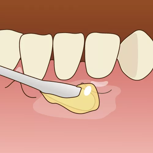 ボロボロの歯の痛みを抑える「表面麻酔」／痛みを抑える「麻酔シール」の画像です