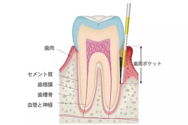 予防歯科のためのポケット検査のイメージ画像