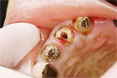 ひどい虫歯で崩壊した歯。エクストリュージョン法で抜歯せず治療できることがある。