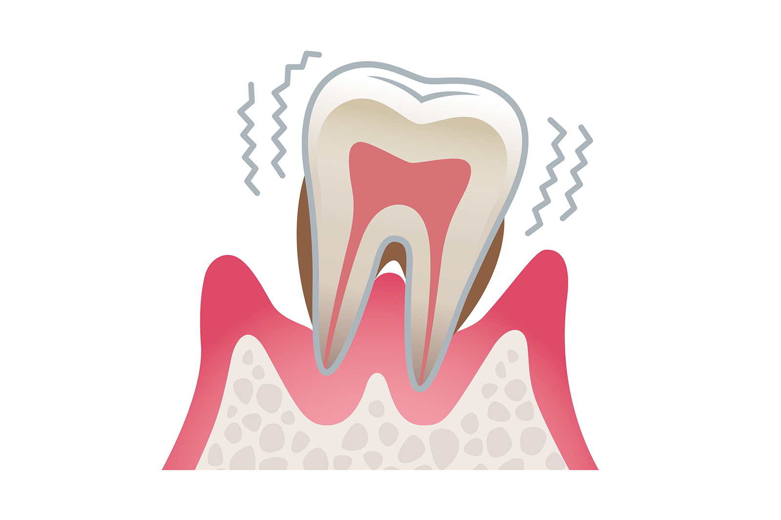 歯周病でグラグラした歯を、歯周組織再生療法で治療