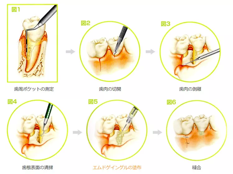 歯周病で溶けた骨を再生するエムドゲイン療法