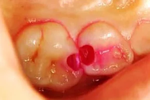 小児歯科の虫歯部位を確かめる写真です