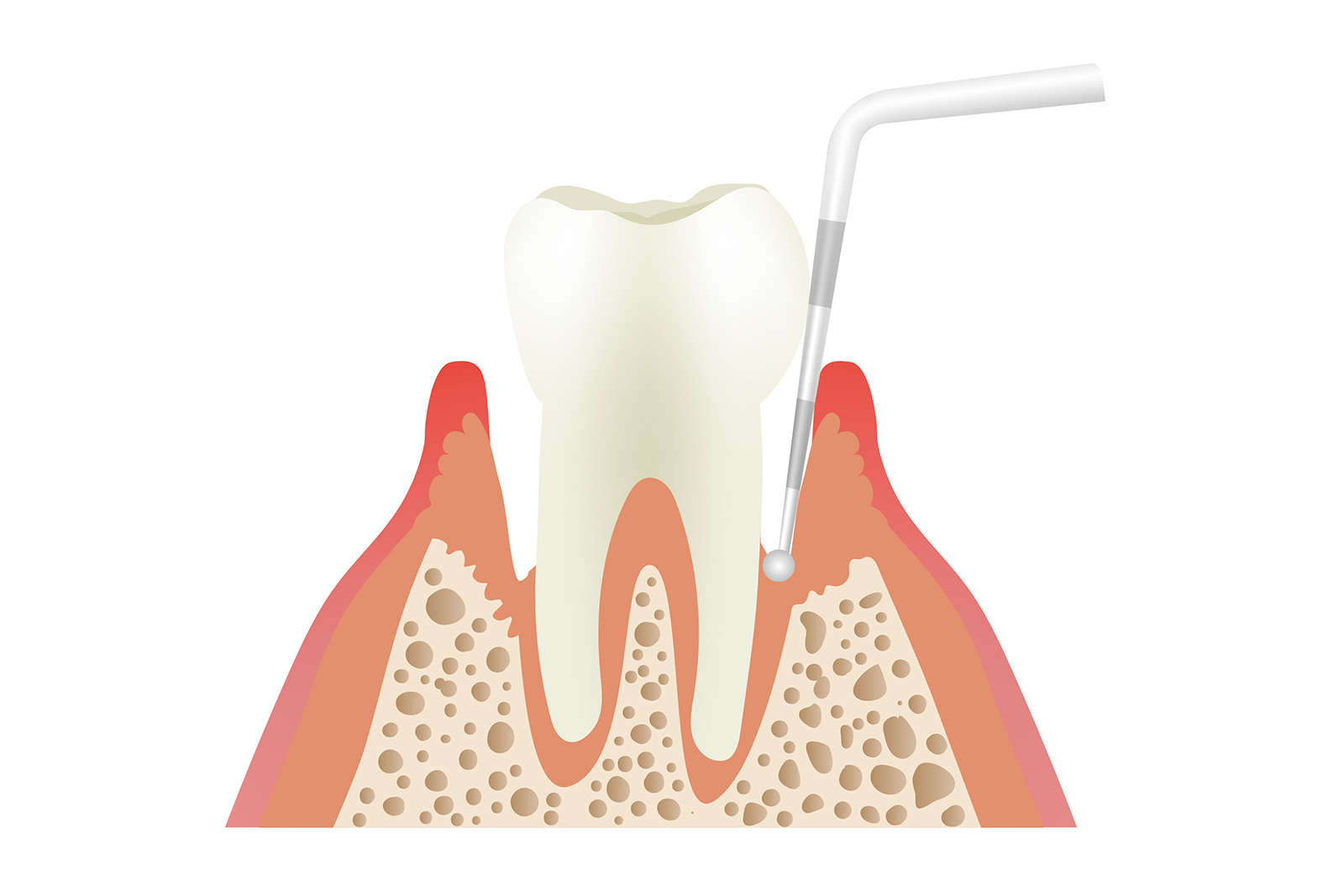歯周病の進行度を調べる歯周ポケット検査