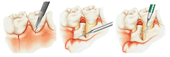 歯周病を外科的に治療する「FOP法」