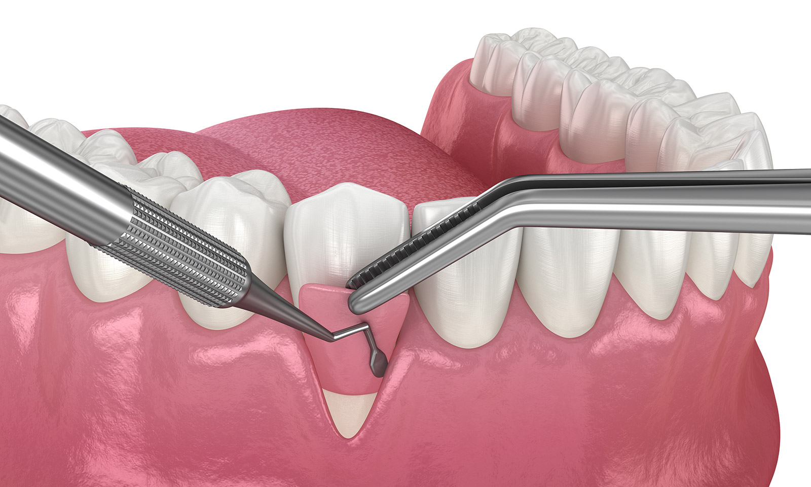 歯周病で退縮した歯茎を、外科的に治療できます