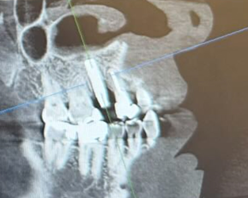 左上5番 インプラント