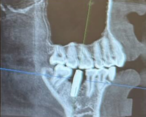 右下6番 インプラント