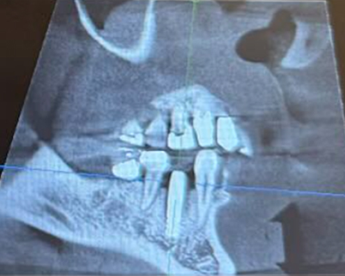 右下4番 インプラント