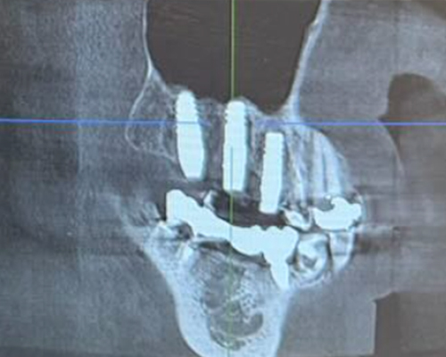 右上567+ソケットリフト