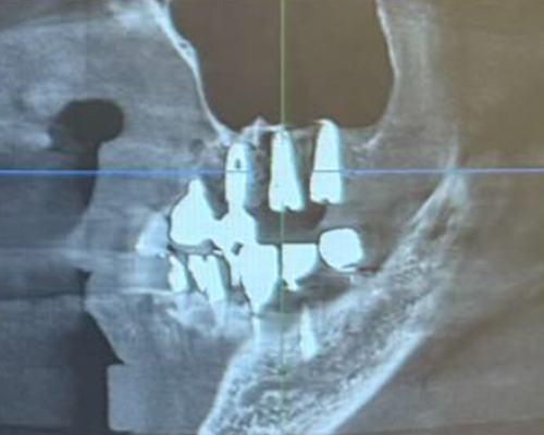 左上67+ソケットリフト