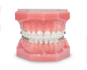 表側ワイヤー矯正の画像