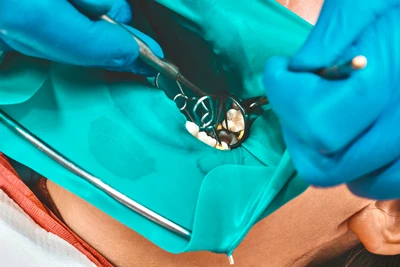 根管治療の成功率を上げるラバーダム